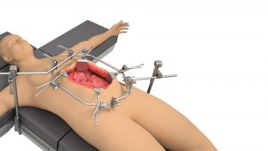 HIPEC Retractor System