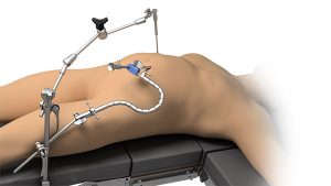 Laparoscopic for Elite Rail Clamp