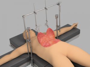 Body Contouring System