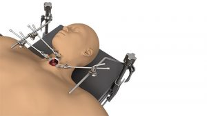 Small Incision System
