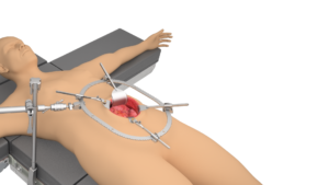 Thompson RingTrack General / Vascular / Trauma System