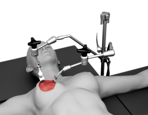 Breast System