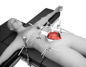 Thompson OneFrame® General / Vascular System